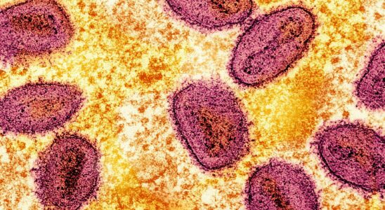 Augmentation des cas de la nouvelle souche mortelle de mpox au Royaume-Uni : avertissement des experts sur sa forte contagiosité