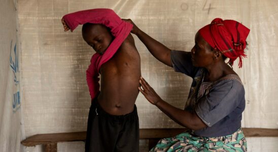 Mpox : Une nouvelle variante en Afrique centrale et des cas signalés en Europe, tout ce qu'il faut savoir sur cette épidémie.